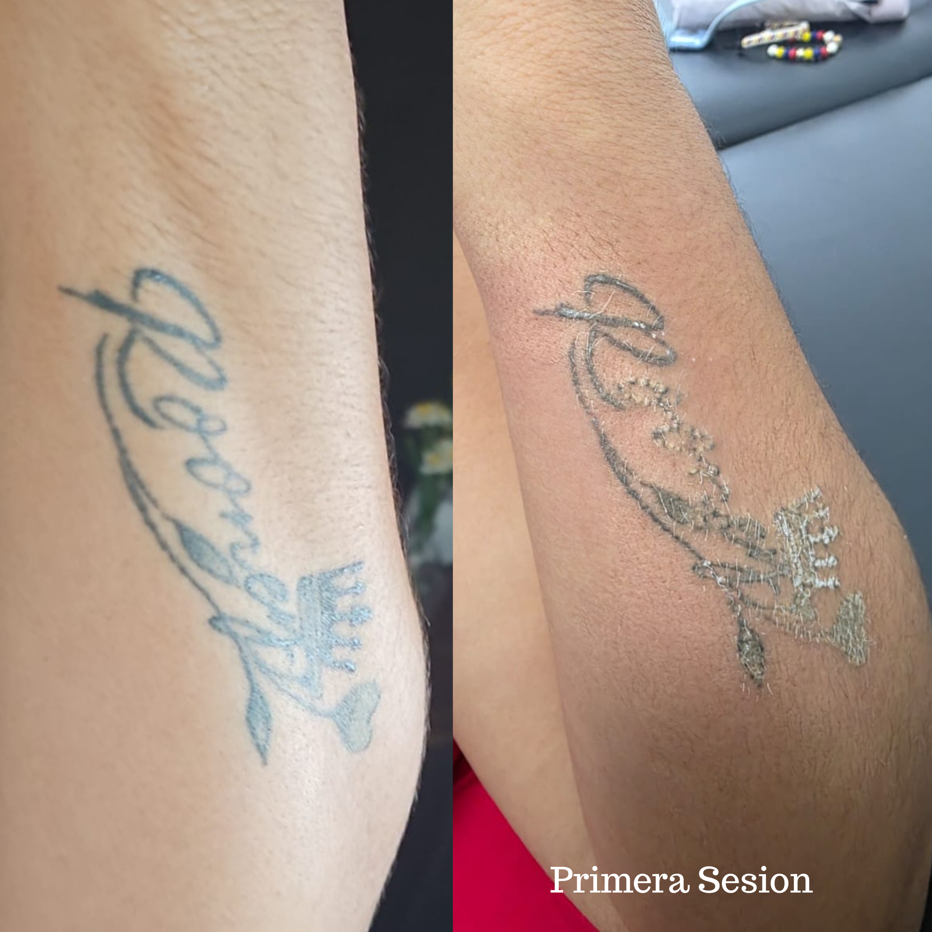 Eliminación de tatuaje