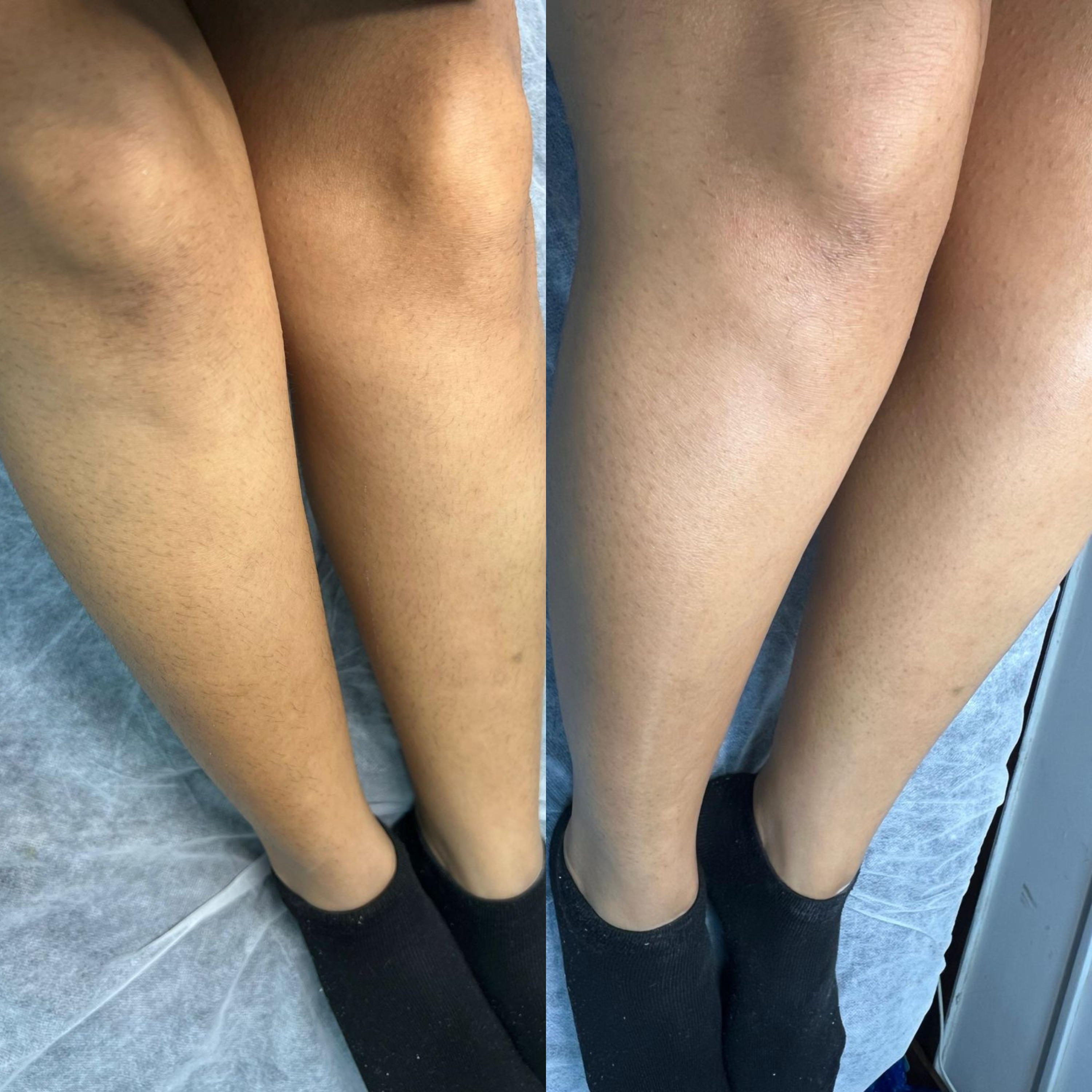 Depilación de piernas
