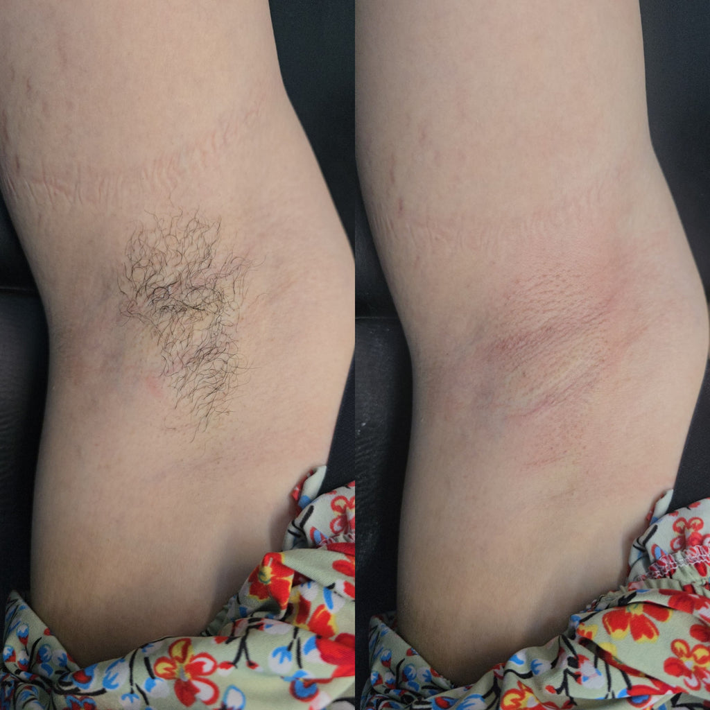 Depilación de Axilas con Cera Profesional