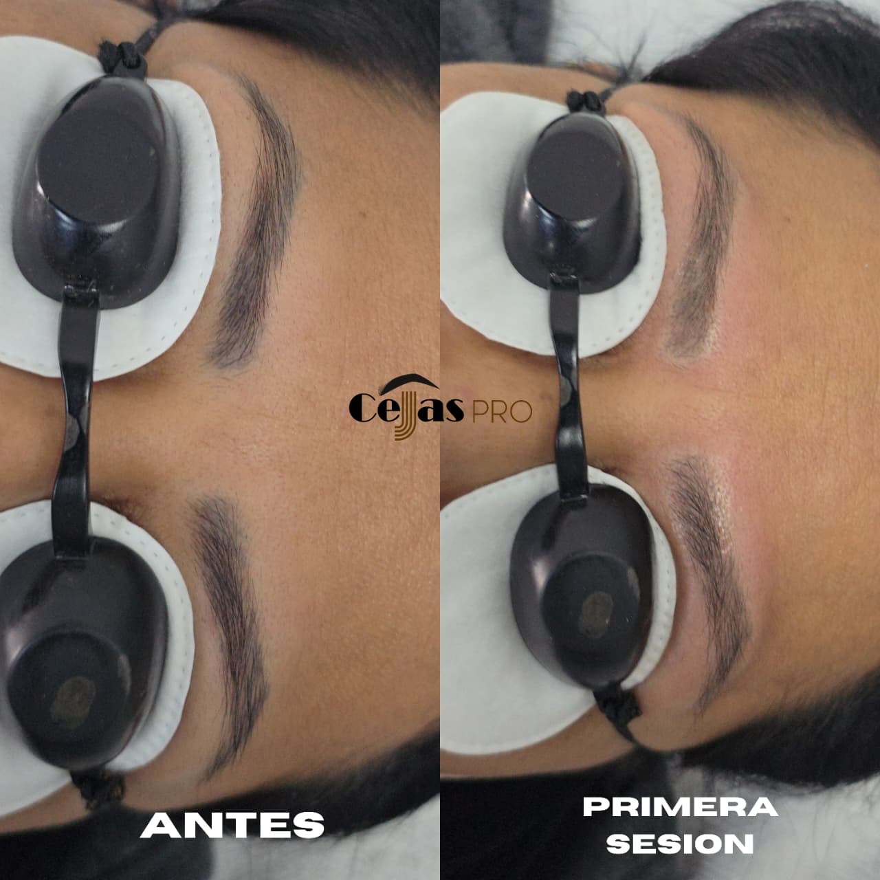 Eliminacion de tatuaje (Cejas)