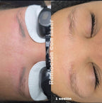 Eliminación de Tatuaje de Cejas | Panama