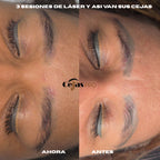Eliminación de Tatuaje de Cejas | Panama